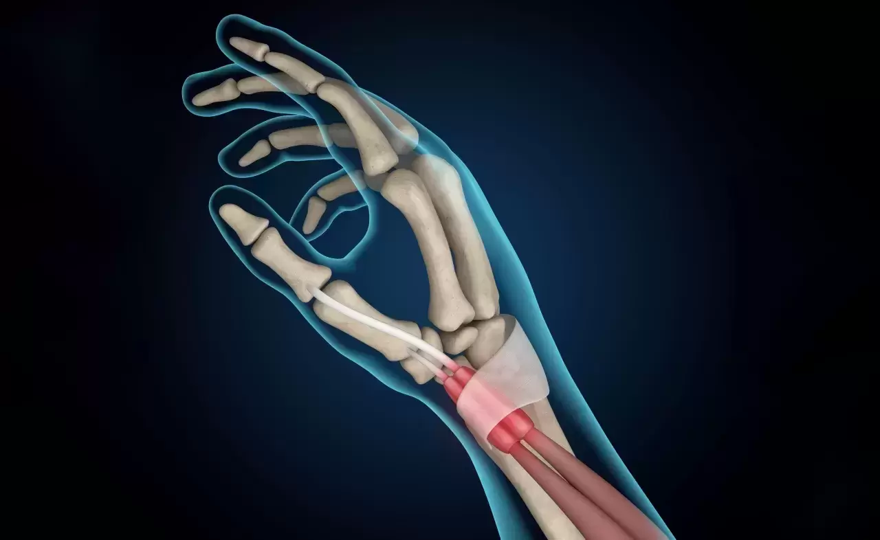 Sehnenscheidenentzündung Tendovaginitis oder Tenosynovitis schmerzhafte Entzündung der Sehnenscheide die die Sehnen umgibt